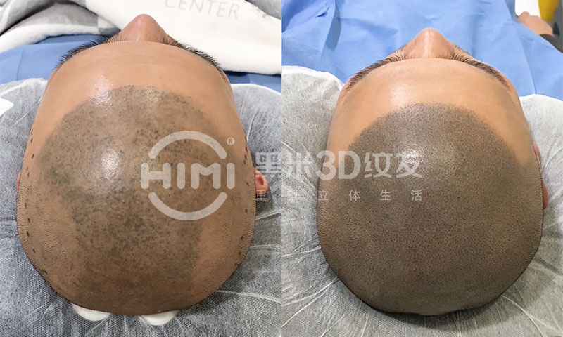 左图常规纹发失败，右图黑米3D纹发修复，效果更立体