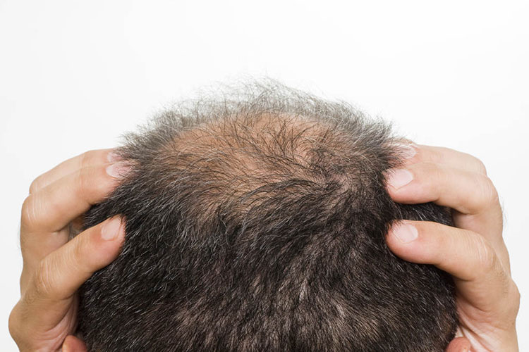 脂溢性脱发的改善方法