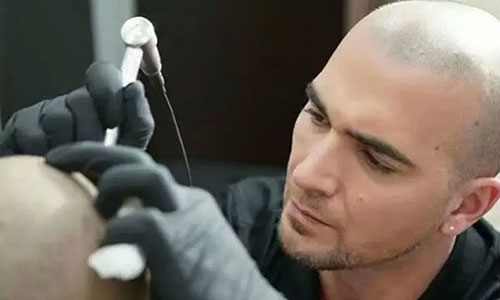 纹发答疑：黑米3D纹发操作时会不会痛？需不需要打麻药？