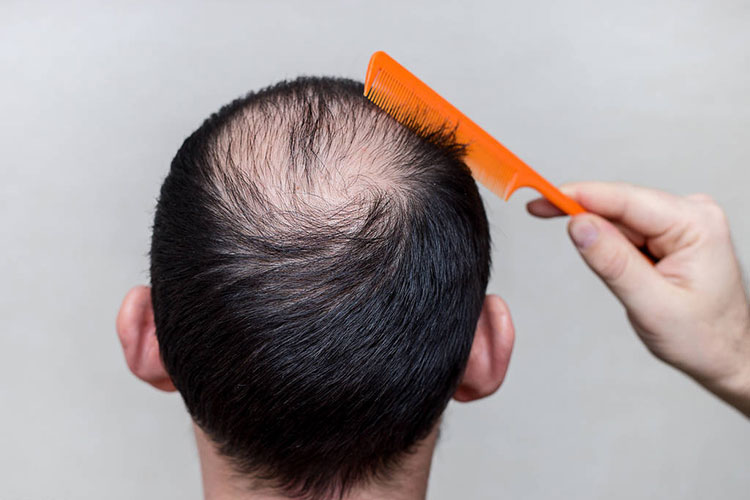 脂溢性脱发的表现