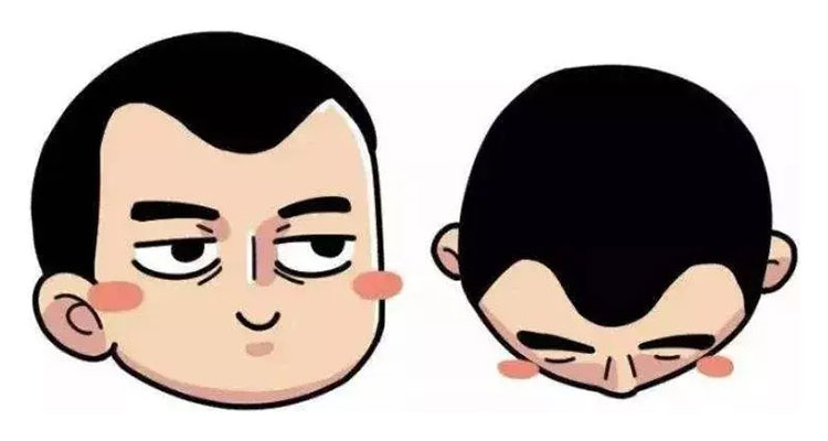 什么是雄性脱发？