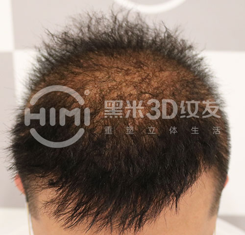 刘先生头顶发旋头发稀疏