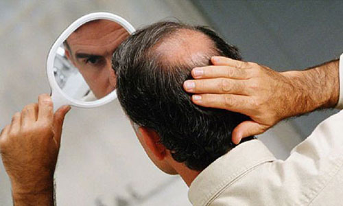 “秃如其来的希望”，黑米3D纹发真的能解决秃顶脱发吗？