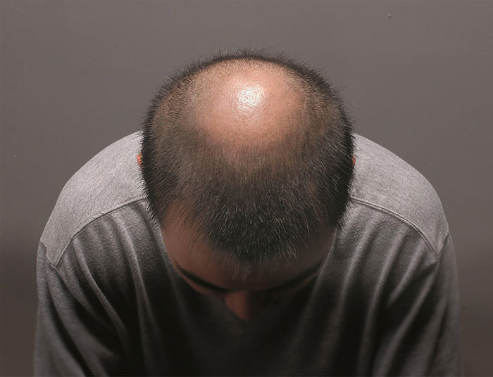 雄激素性脱发