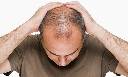 脱发人的救赎:治疗VS纹发,哪种方案更适合你?