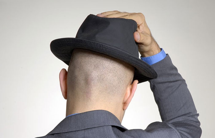 男性戴帽子掩饰头皮脱发