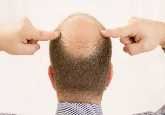 男性脱发，该选择植发还是纹发