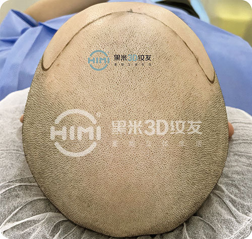 头顶脱发操作黑米3D纹发前的样子