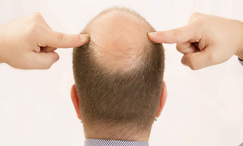 黑米纹发：平时掉发能再生，为何秃顶就难恢复？