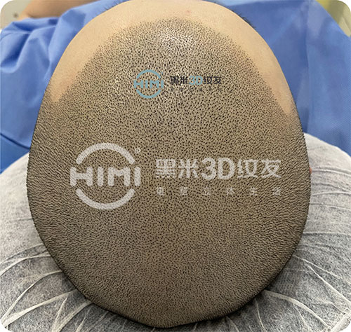 头顶脱发操作黑米3D纹发后的样子