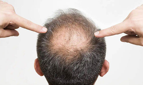 秃头经济爆发！黑米纹发黑科技走红，年轻人告别秃头形象新选择