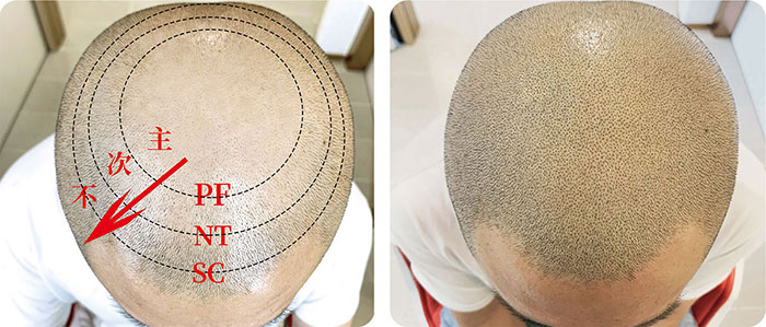 黑米3D纹发PF/NT/SC技术