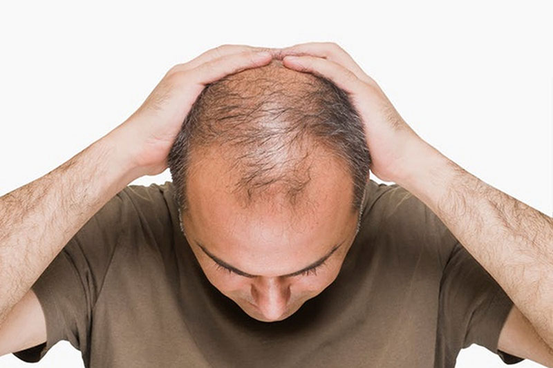 脱发严重发际线高的原因