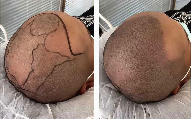 在头皮上进行适当的标记和设计