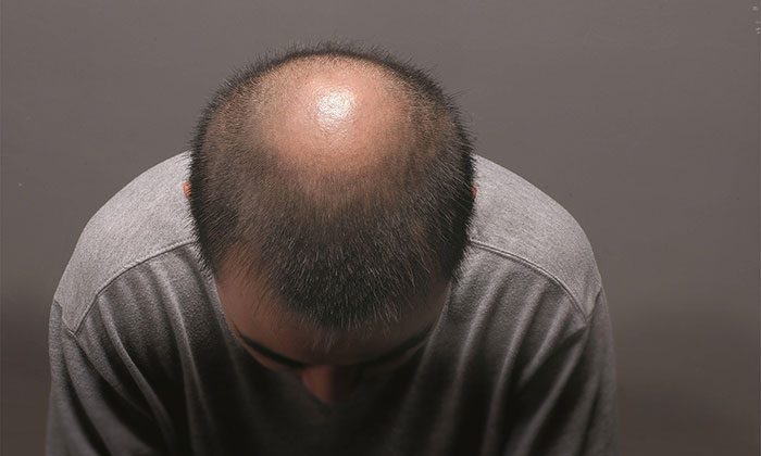 纹发后会长出自己的头发吗？