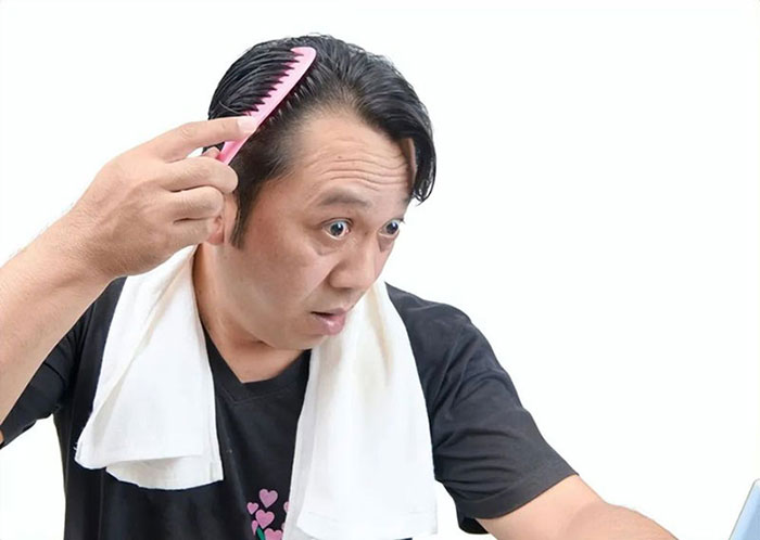 一位男士脱发，发际线靠后