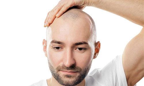 健身猛男脱发更显老?纹发如何让秃头秒变型男