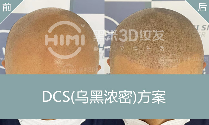 周先生咨询秃头纹发以后还是光头吗