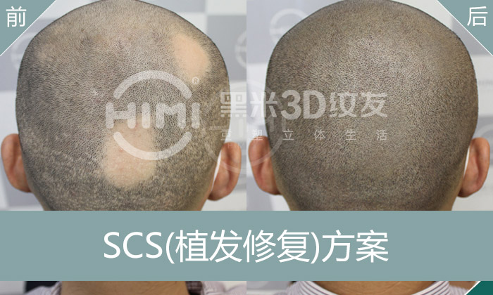 黑米3D纹发SCS植发修复方案