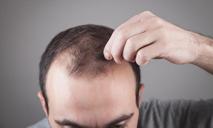 32岁的程序员张先生曾因M型脱发陷入相亲困境