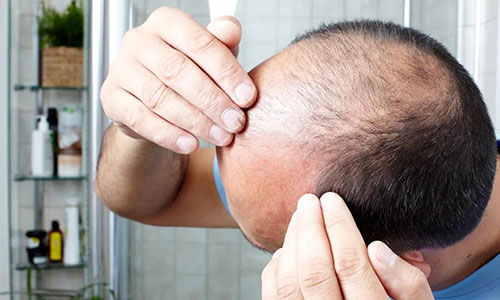 男生掉发脱发严重怎么解决?纹发 + 3 大方法助改善