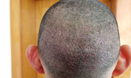 黑米纹发：警惕！植发后的隐患与后遗症你知道多少？