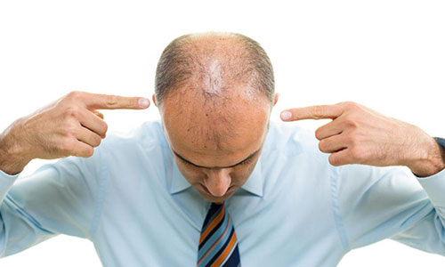 遗传脱发去植发可以吗？可以但不建议！纹发或是更优解