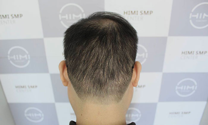 植发之后，后枕部留下疤痕