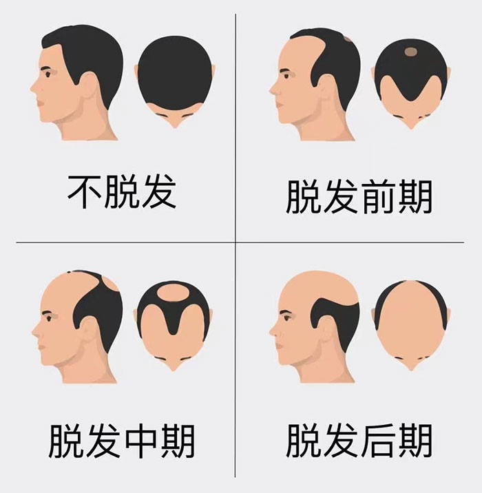 脱发程度