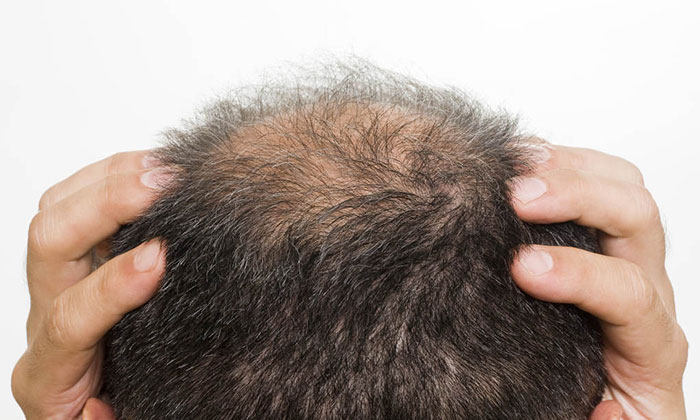 植发后，头发还会脱落吗？