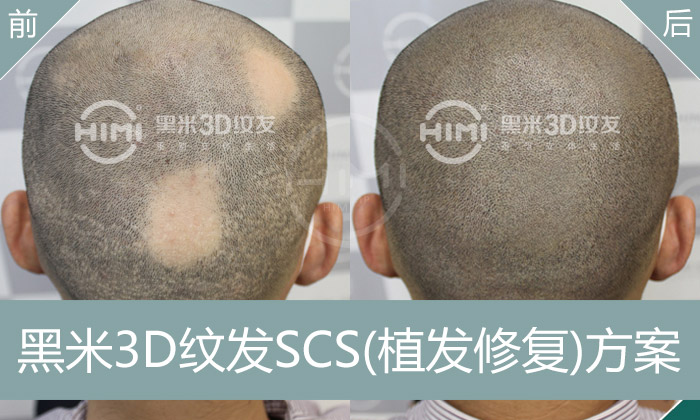 黑米3D纹发解决斑秃困扰