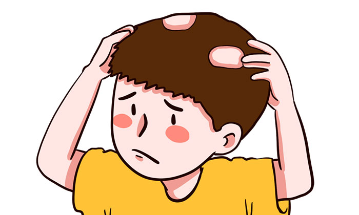 斑秃怎么办？