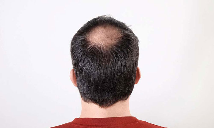 头顶纹发新选择，轻松解决脱发困扰