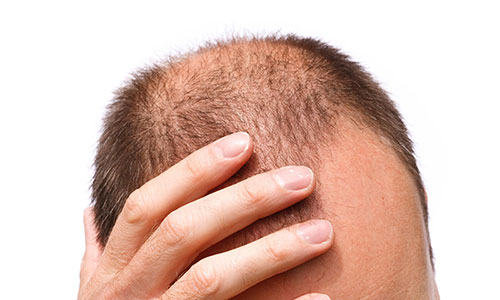 脱发的原因有哪些?短时间改善脱发,纹发技术靠谱吗?