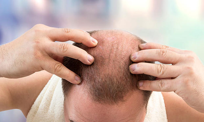 毛囊坏死并非定局，除了植发，还可借助3D纹发重回浓密头发！