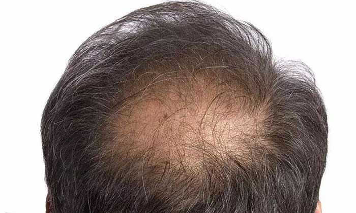 3d纹发跟植发区别