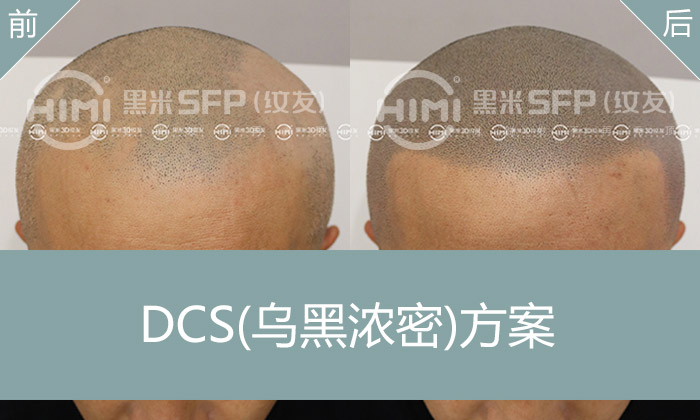 斑秃纹发后效果