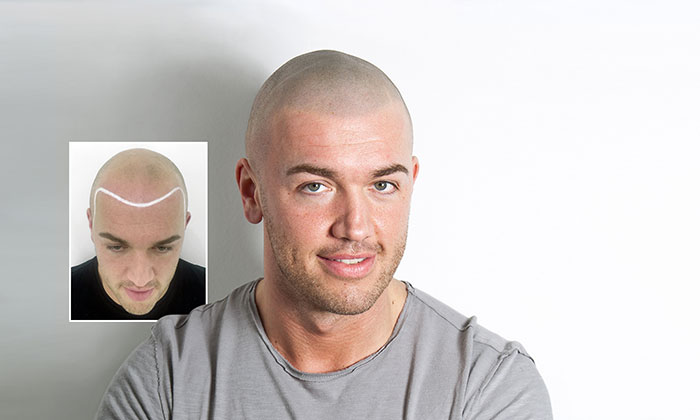 纹发前后效果对比