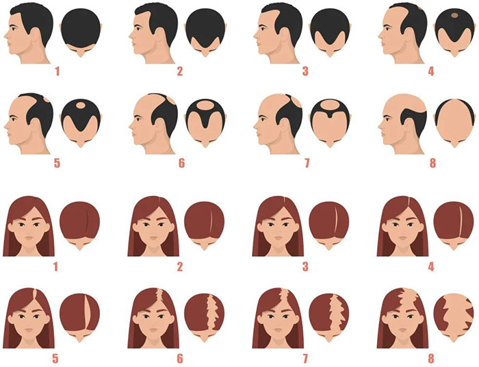 脱发程度参考图