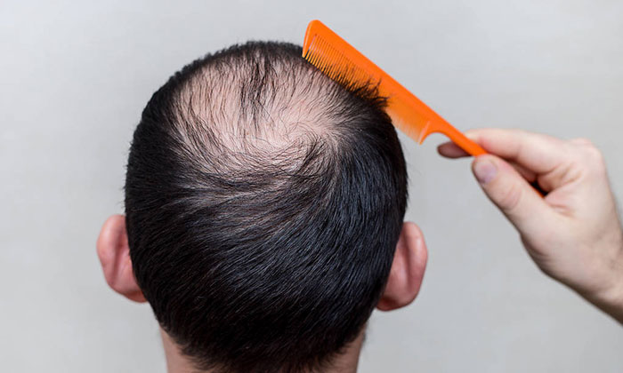 怎样能够延迟脱发