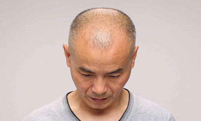 人到中年就开始脱发秃顶吗？