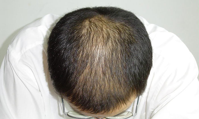 头顶稀疏的男性