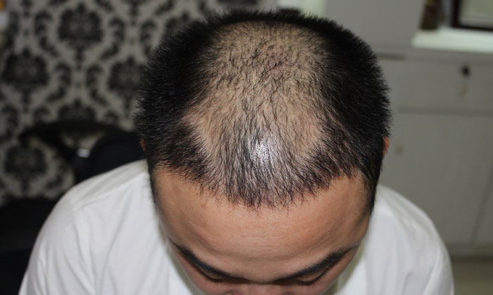 植发后头发稀疏