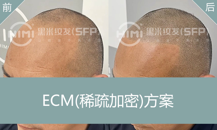 张先生M性发际线后移，纹发重塑发际线，重获自信