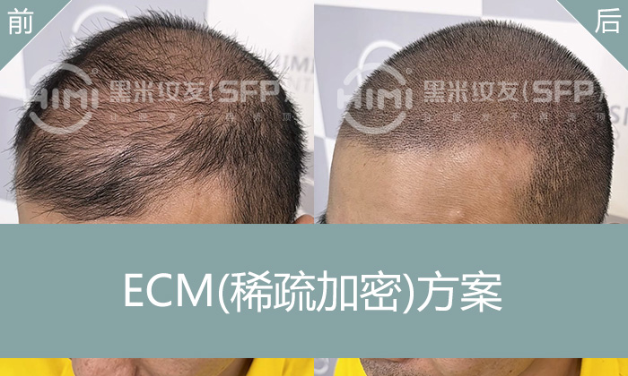 吴先生8年脱发改善实录：头顶稀疏纹发加密真实效果对比