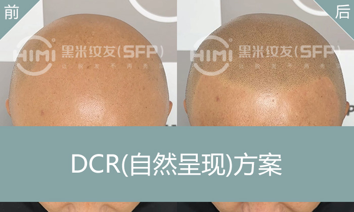 王先生18年脱发逆袭！纹发技术重塑浓密寸头，告别秃顶尴尬