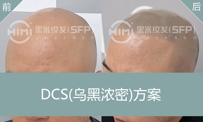 严重秃顶怎么办？纹发寸头真实案例解析 - 石先生蜕变之路