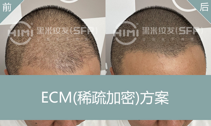 李先生头顶稀疏怎么办？加密纹发解决脱发困扰