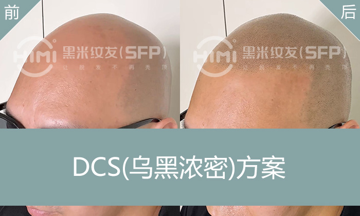 大面积脱发怎么办？广州曹先生纹发案例，浓密寸头自然帅气