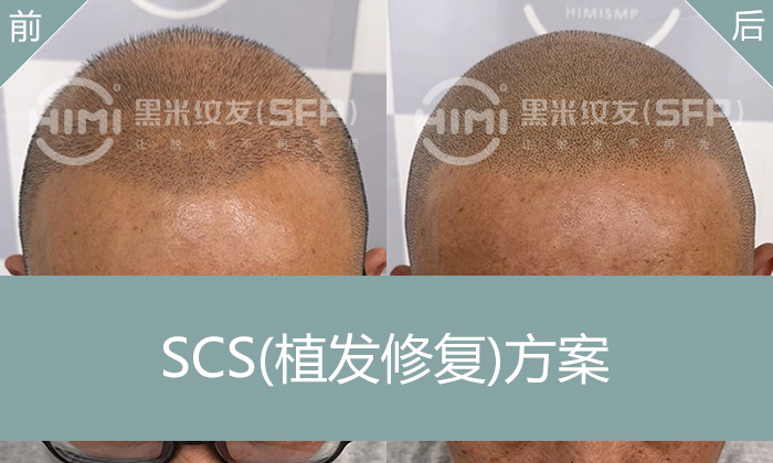 植发失败？武汉曾先生纹发加密头顶重获新生